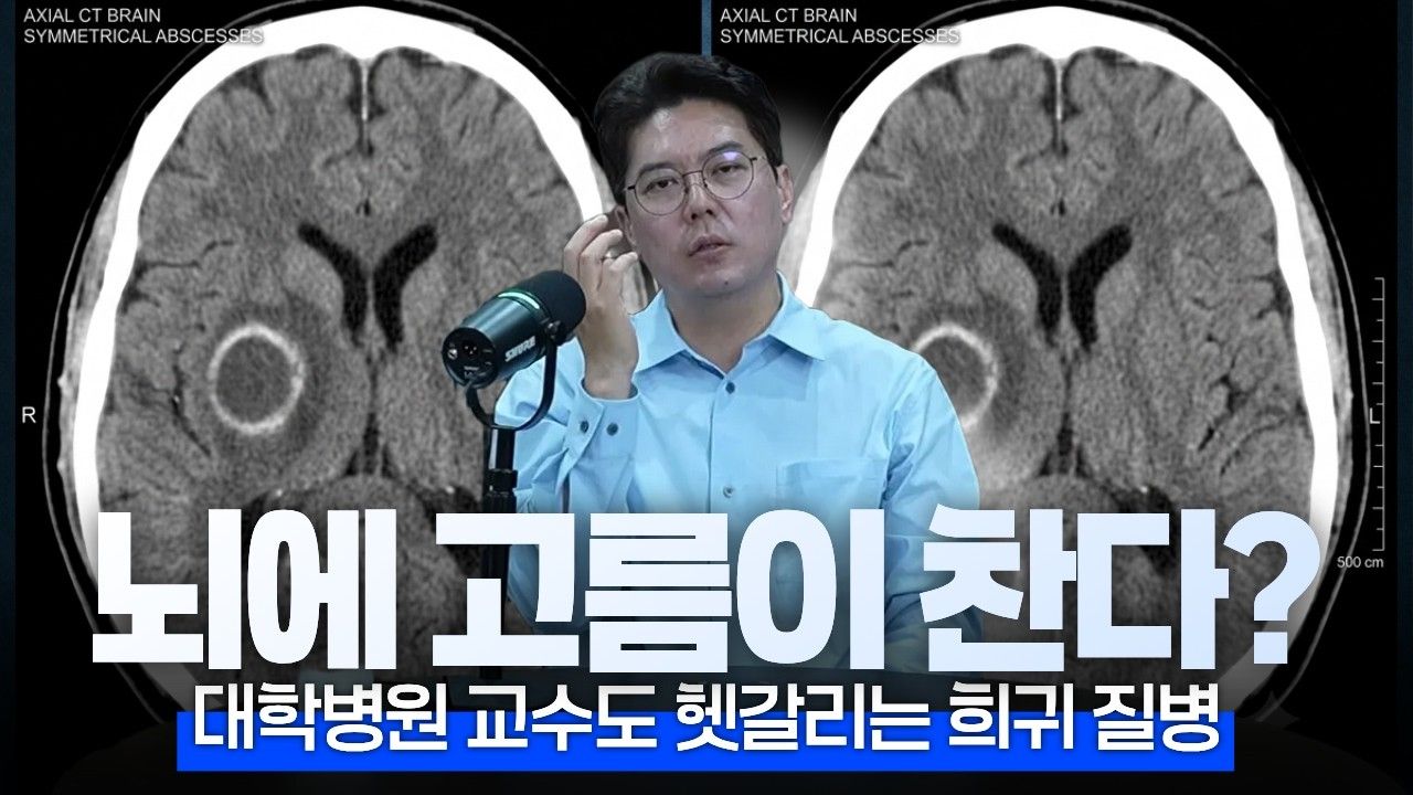 치아 감염이 뇌까지 갈 수 있습니다